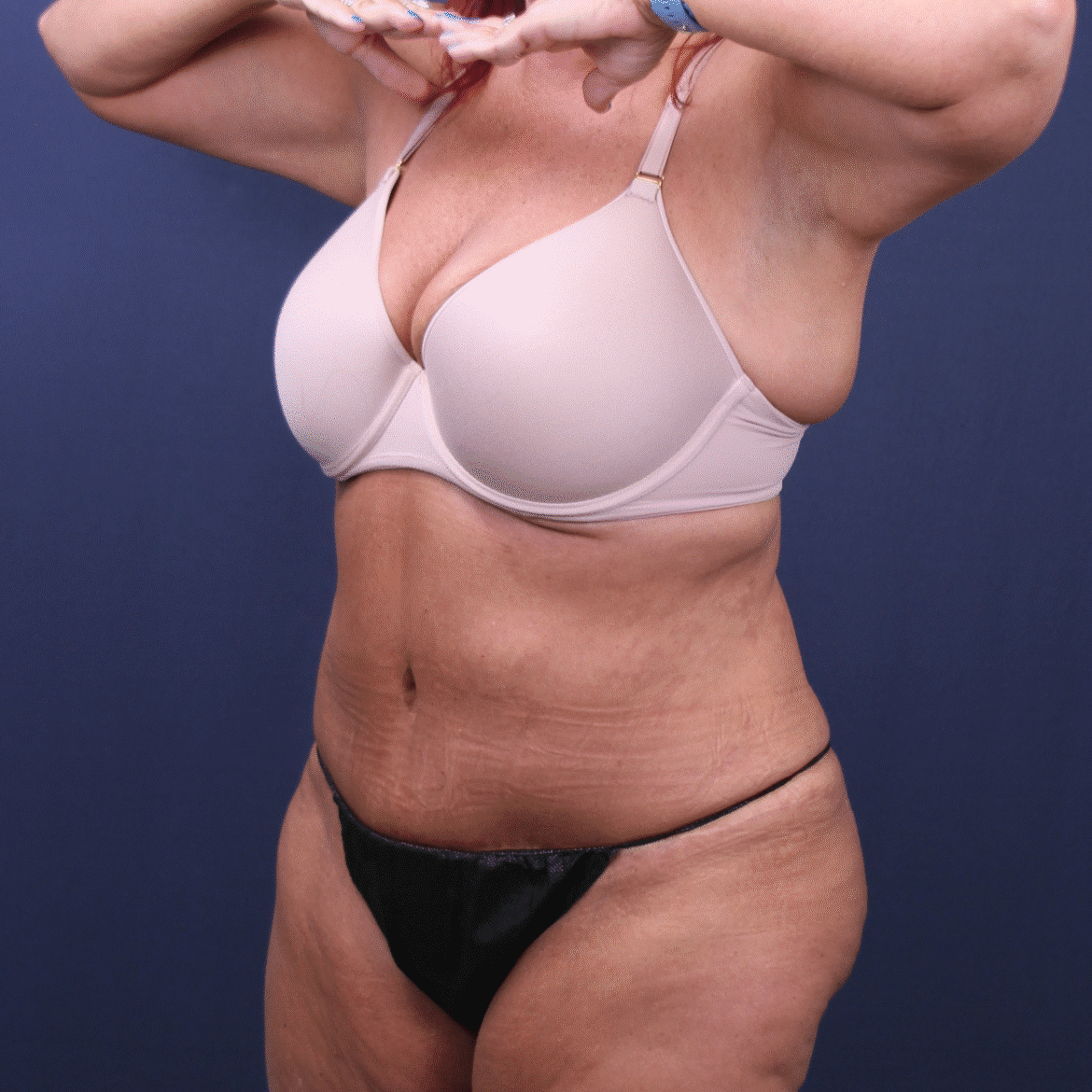 After Image: Extended Bella Body Lift - left-front-oblique