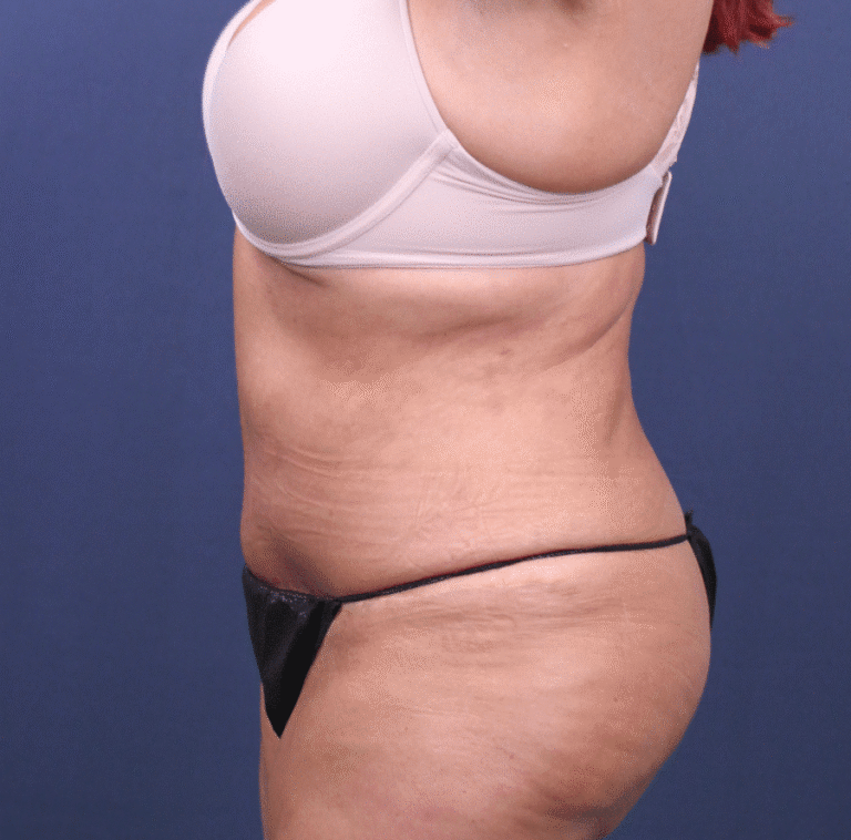 After Image: Extended Bella Body Lift - left-side