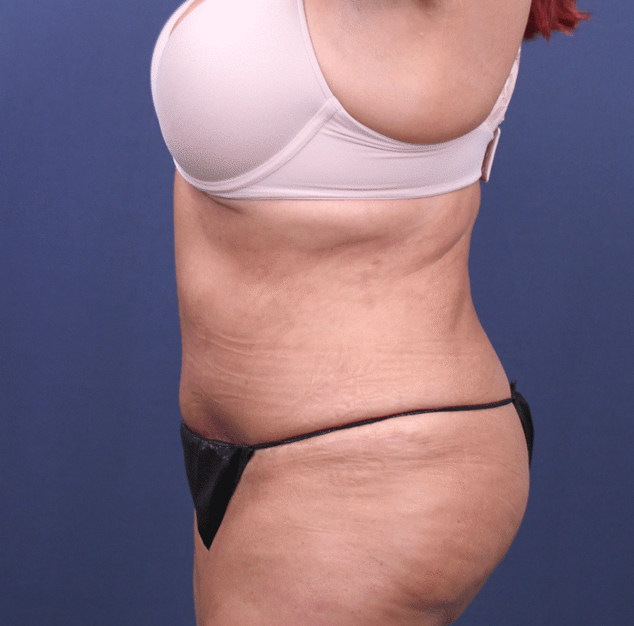 After Image: Extended Bella Body Lift - left-side