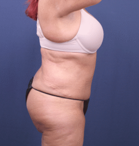 After Image: Extended Bella Body Lift