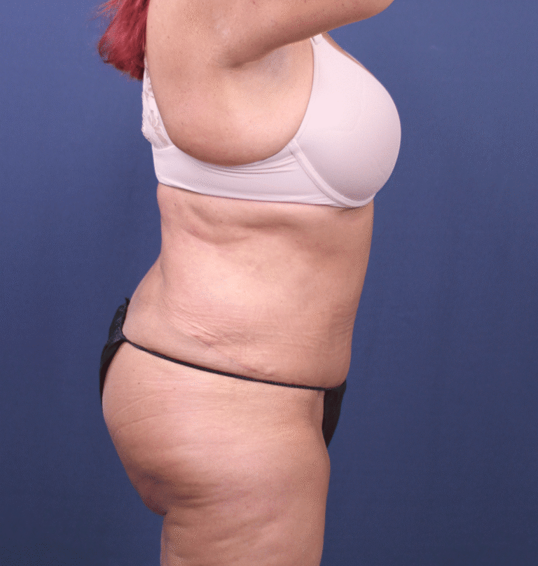 After Image: Extended Bella Body Lift - right-side