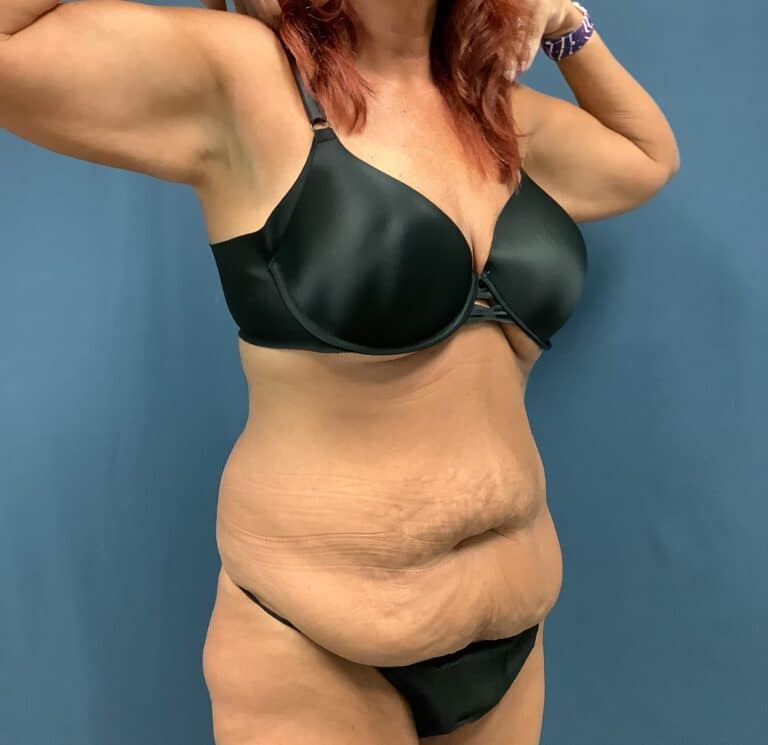 Before Image: Extended Bella Body Lift - right-front-oblique