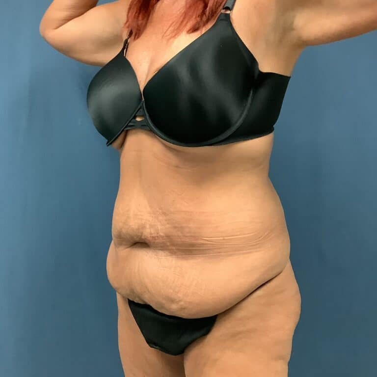 Before Image: Extended Bella Body Lift - left-front-oblique