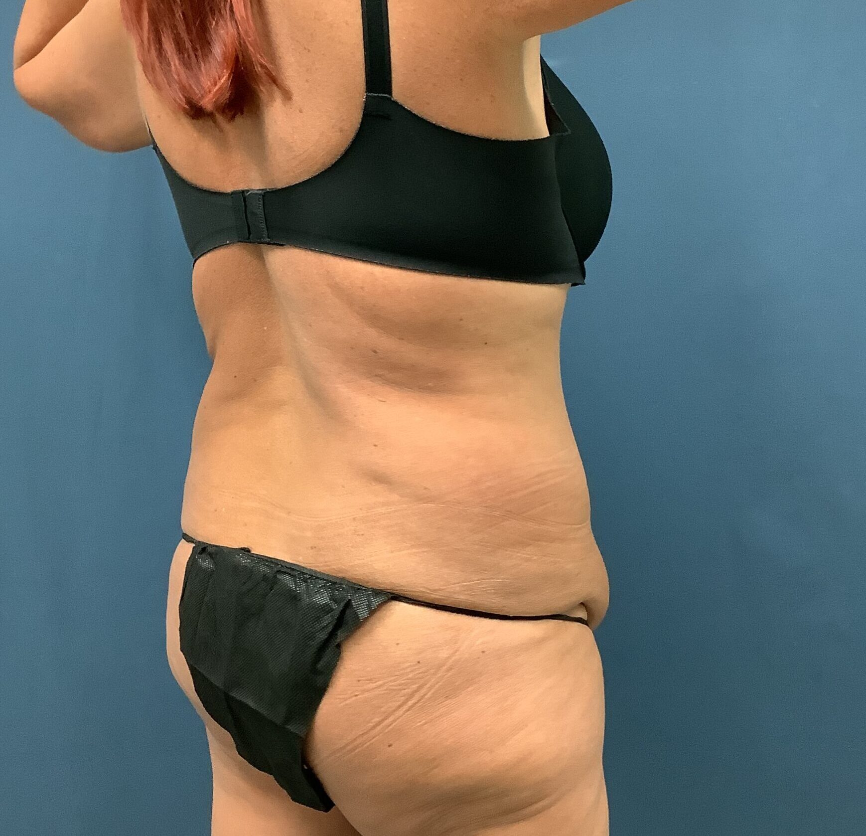 Before Image: Extended Bella Body Lift - right-back-oblique