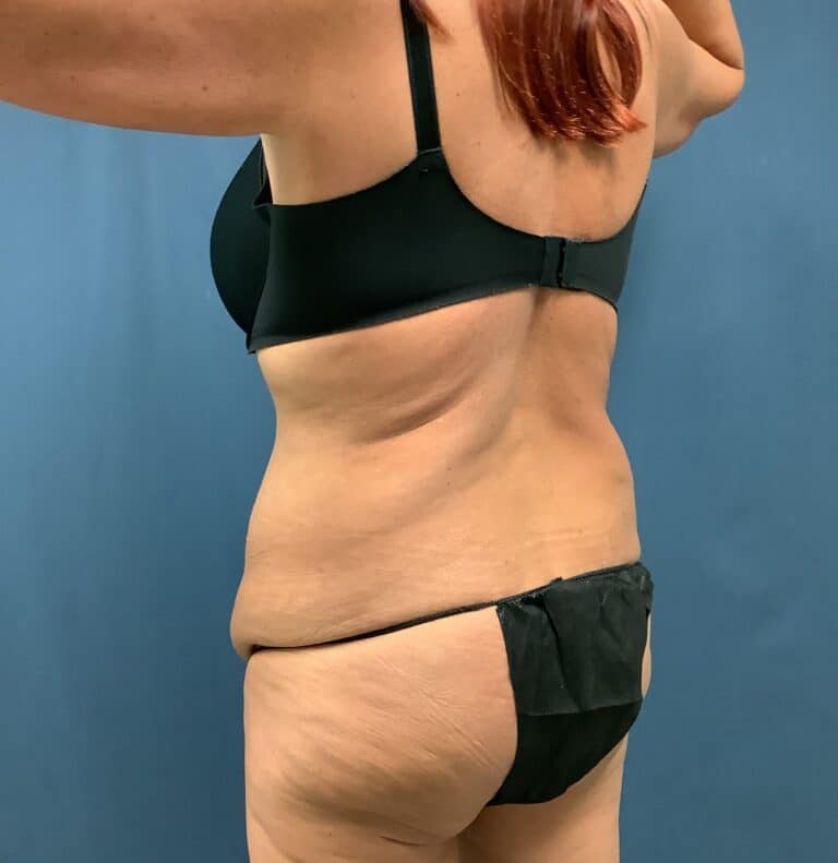Before Image: Extended Bella Body Lift - left-back-oblique