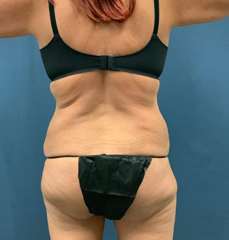 Before Image: Extended Bella Body Lift - back