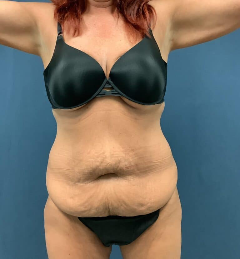 Before Image: Extended Bella Body Lift - front