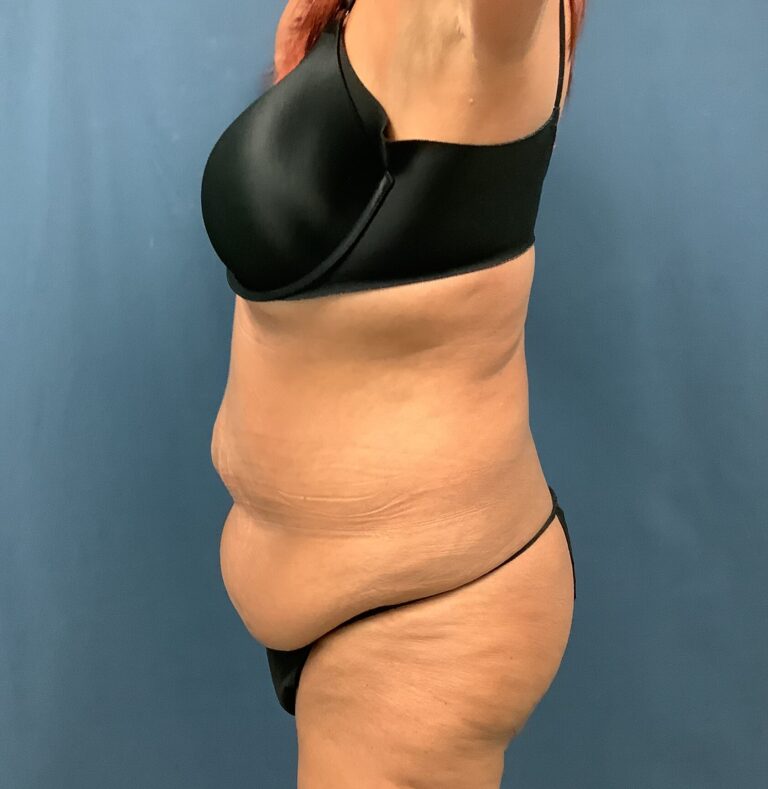 Before Image: Extended Bella Body Lift - left-side
