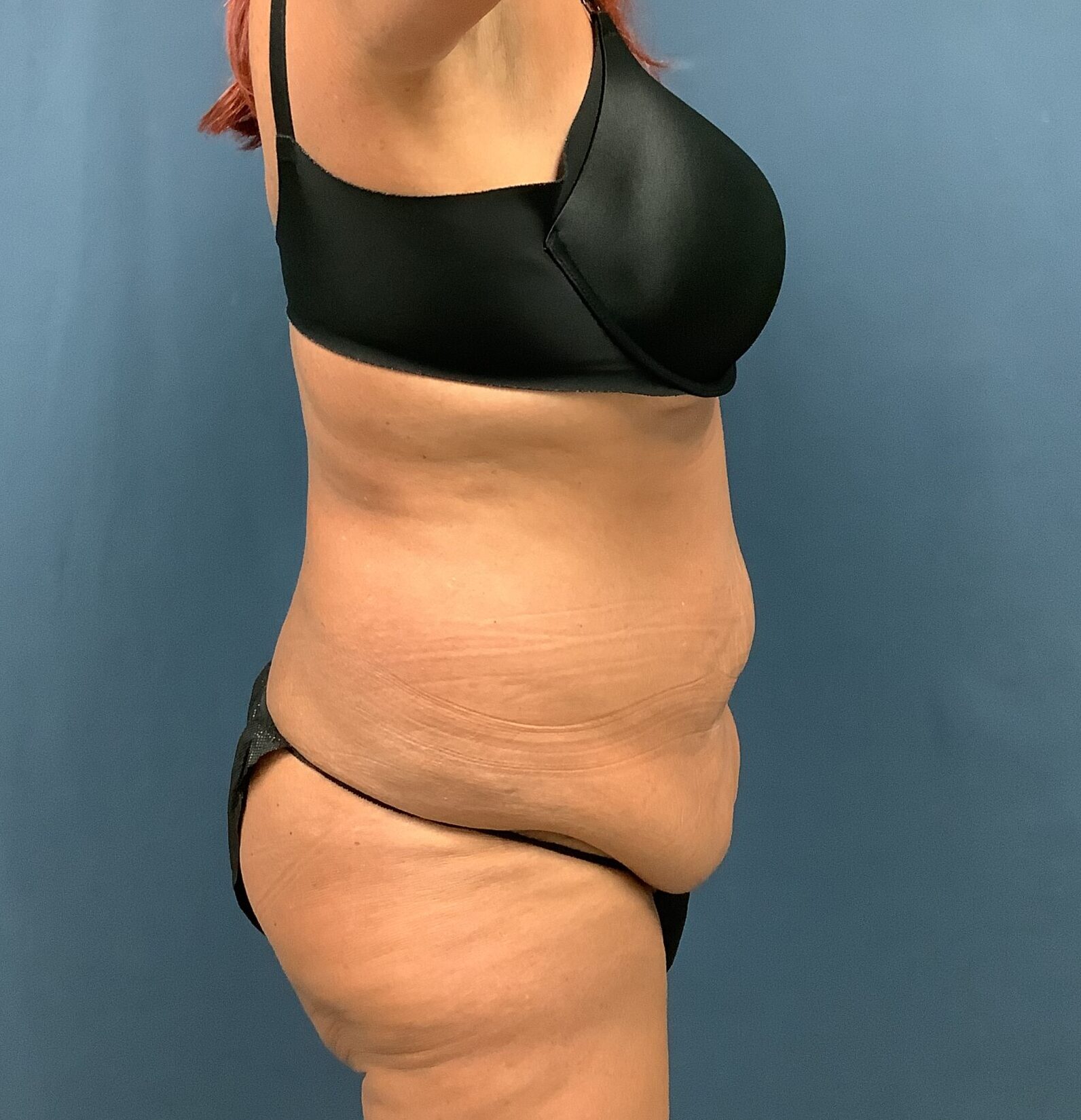 Before Image: Extended Bella Body Lift - right-side