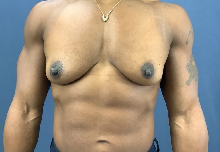 Before Image: Breast Augmentation - front
