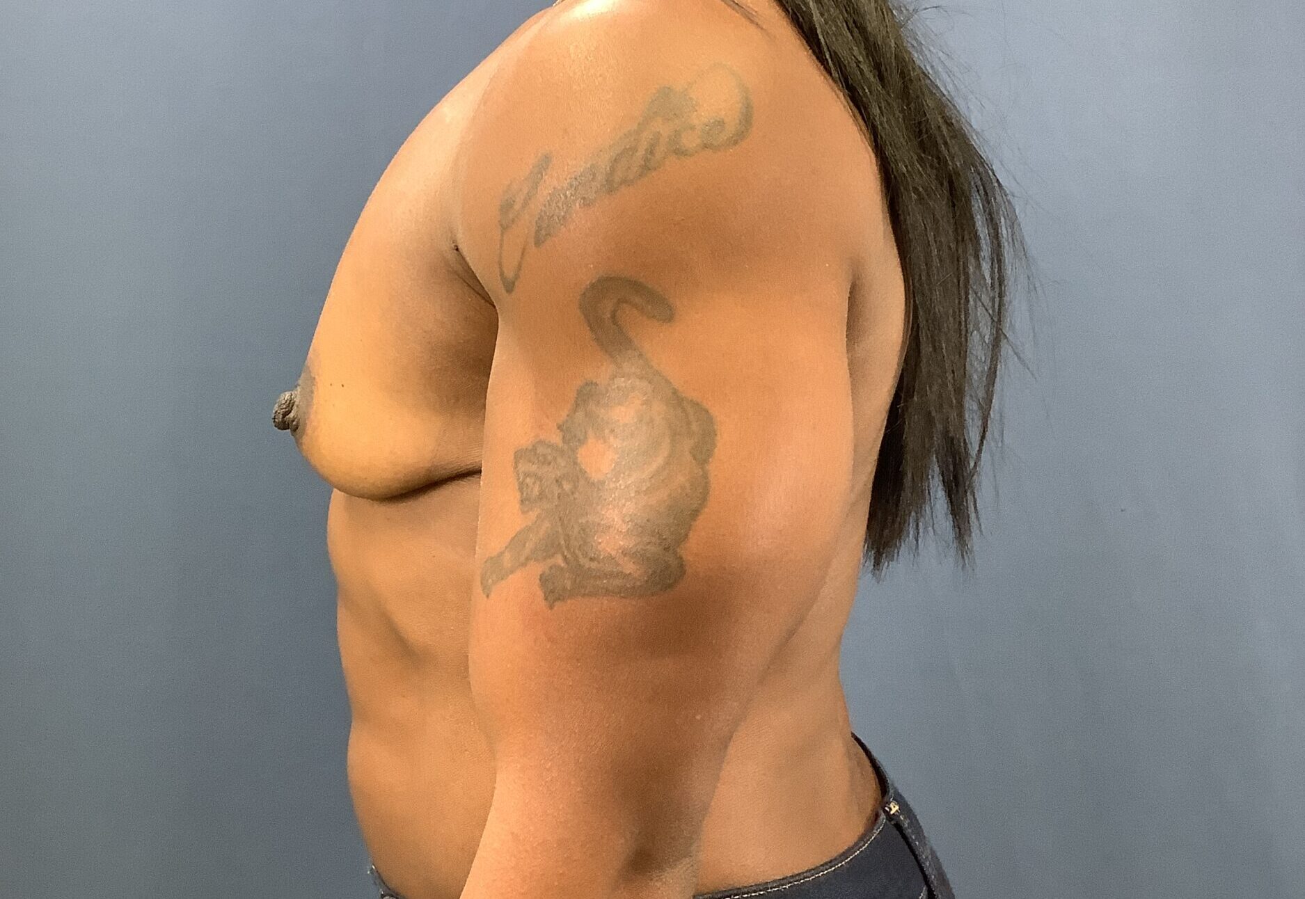 Before Image: Breast Augmentation - left-side