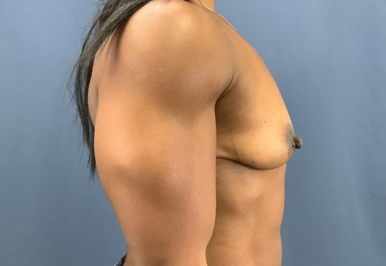 Before Image: Breast Augmentation - right-side