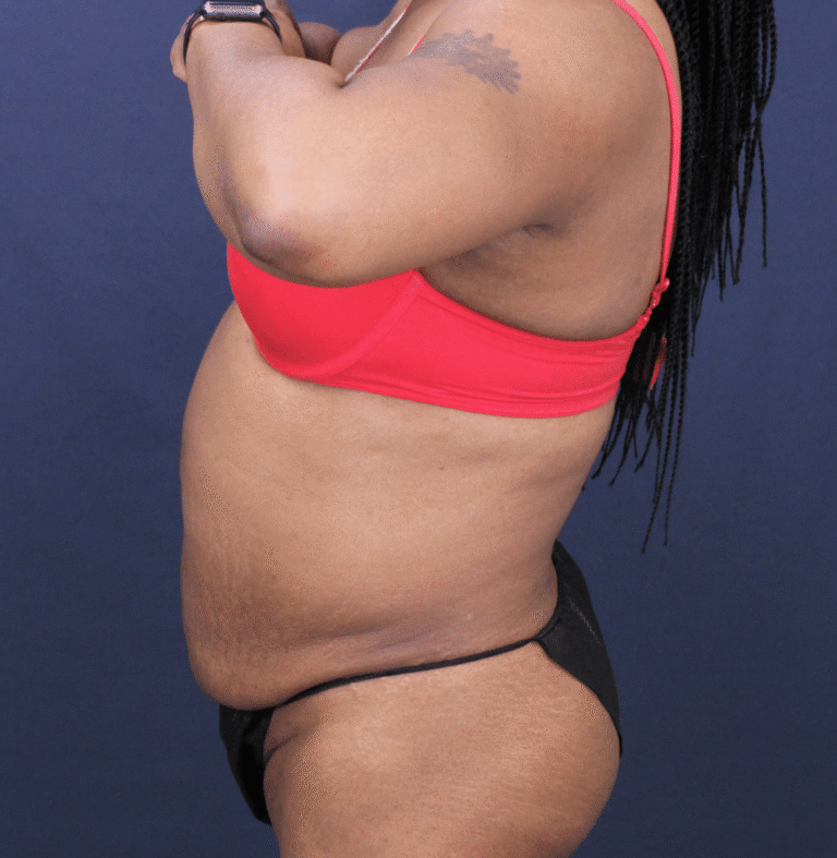 Before Image: Bella Body Lift - left-side