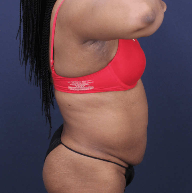 Before Image: Bella Body Lift - right-side