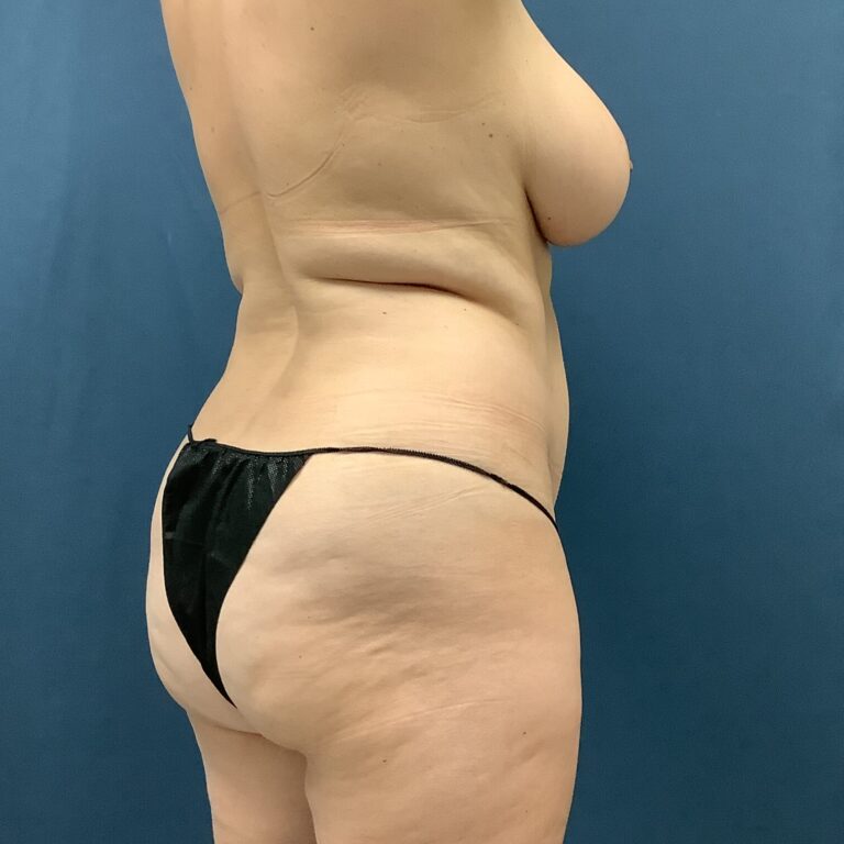Before Image: Bella Body Lift - right-back-oblique