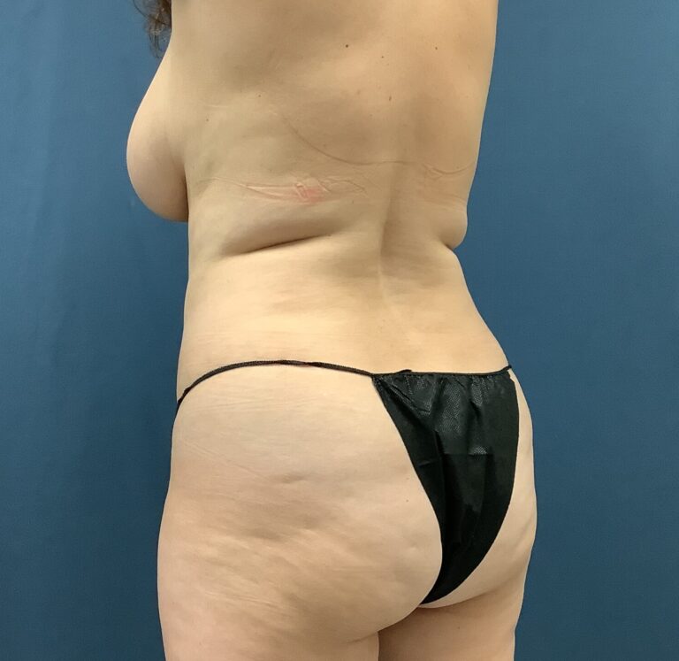 Before Image: Bella Body Lift - left-back-oblique