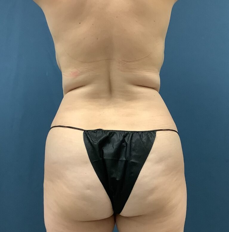 Before Image: Bella Body Lift - back