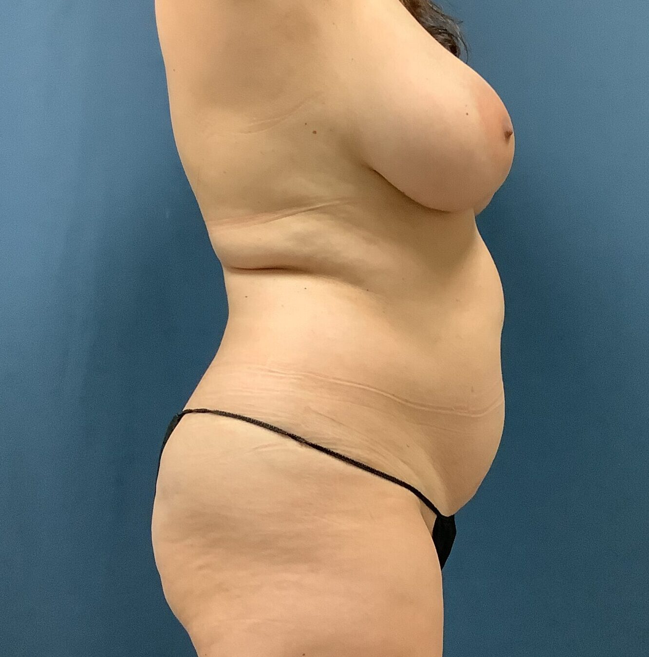 Before Image: Bella Body Lift - right-side