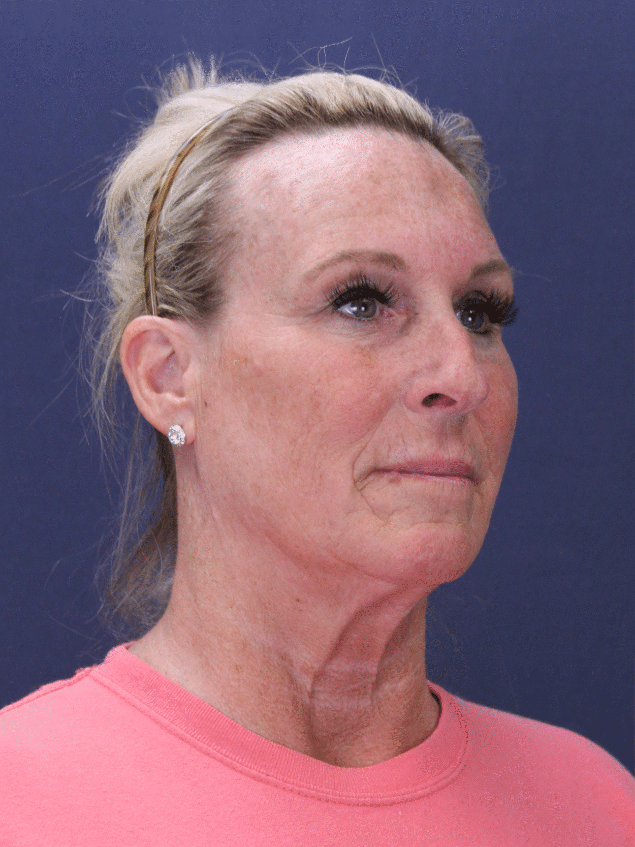 Before Image: Deep Plane Face & Neck lift, Upper Blepharoplasty, Facial fat grafting - right-front-oblique