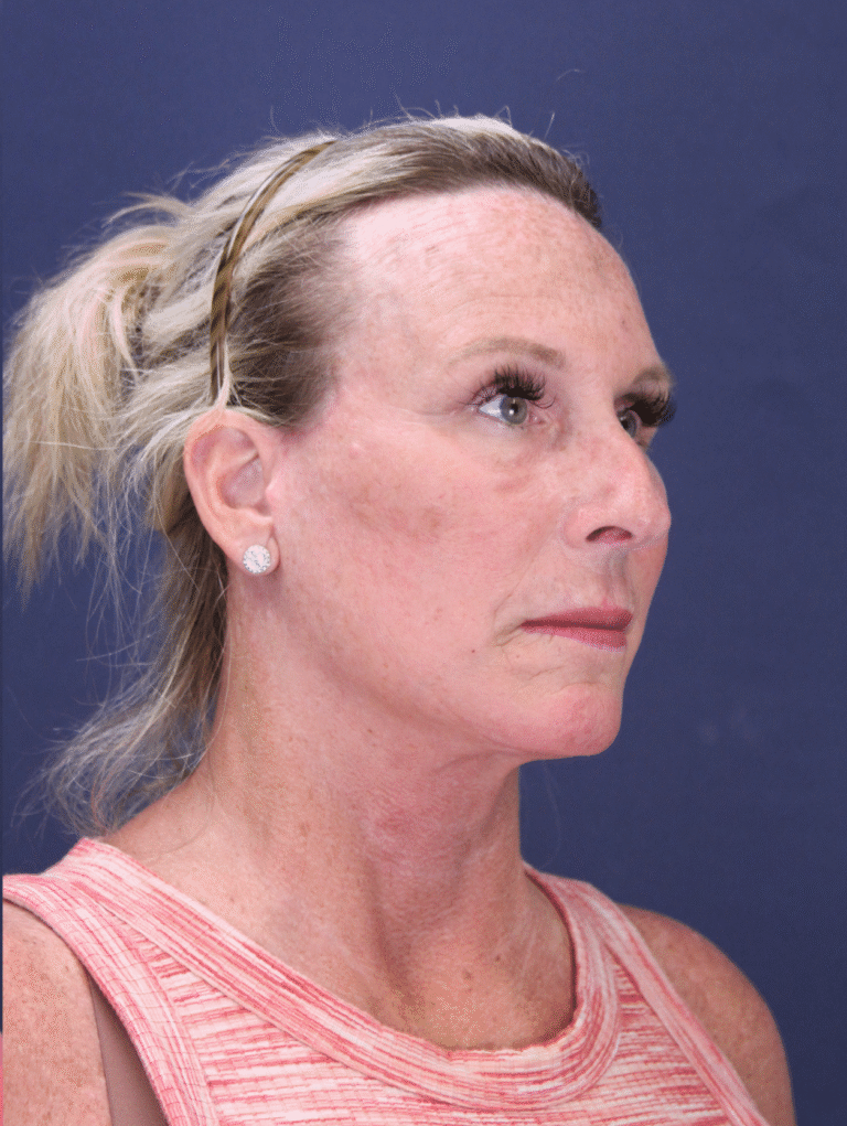 After Image: Deep Plane Face & Neck lift, Upper Blepharoplasty, Facial fat grafting - right-front-oblique