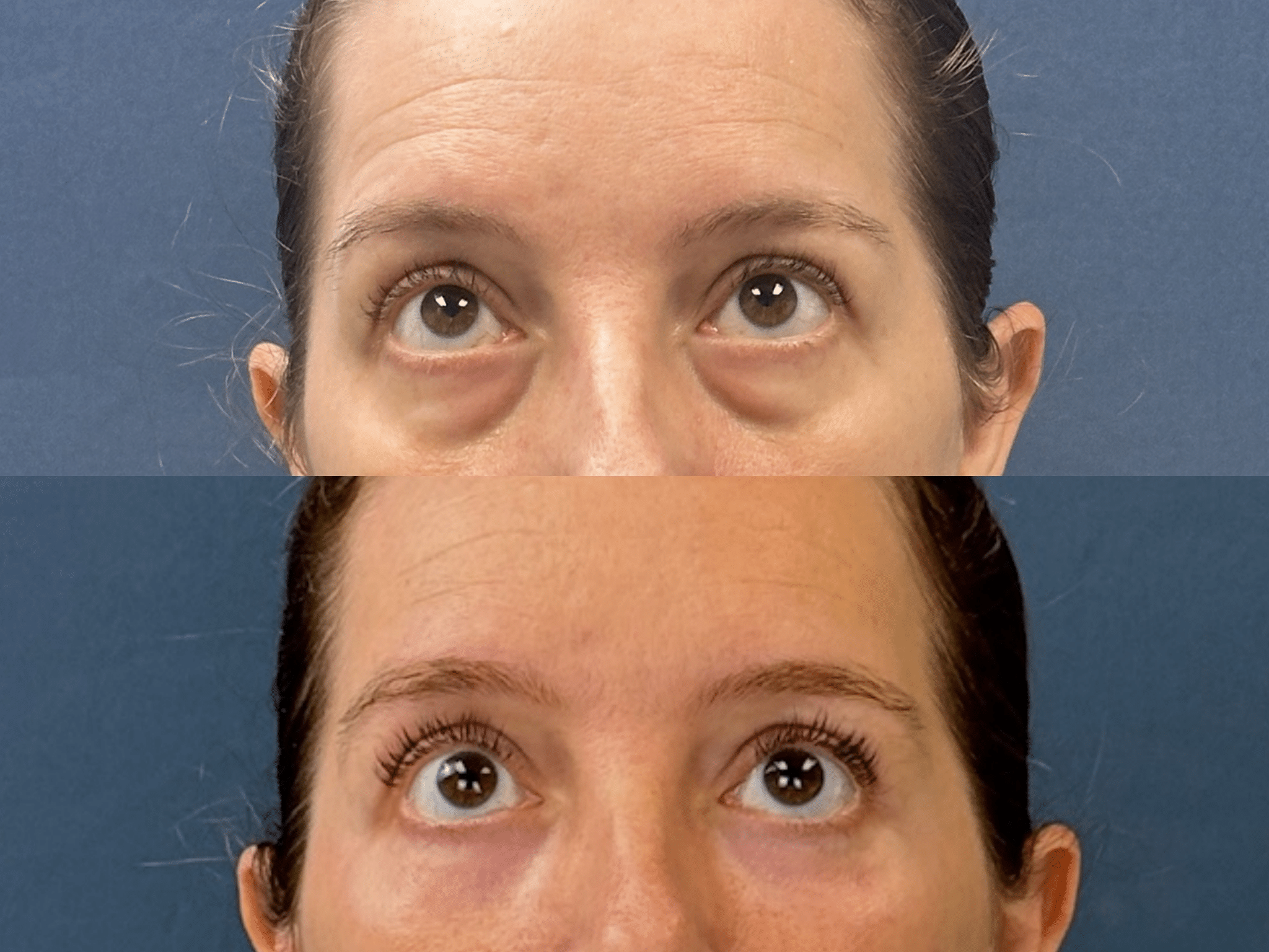 Case19 eyes zoomed