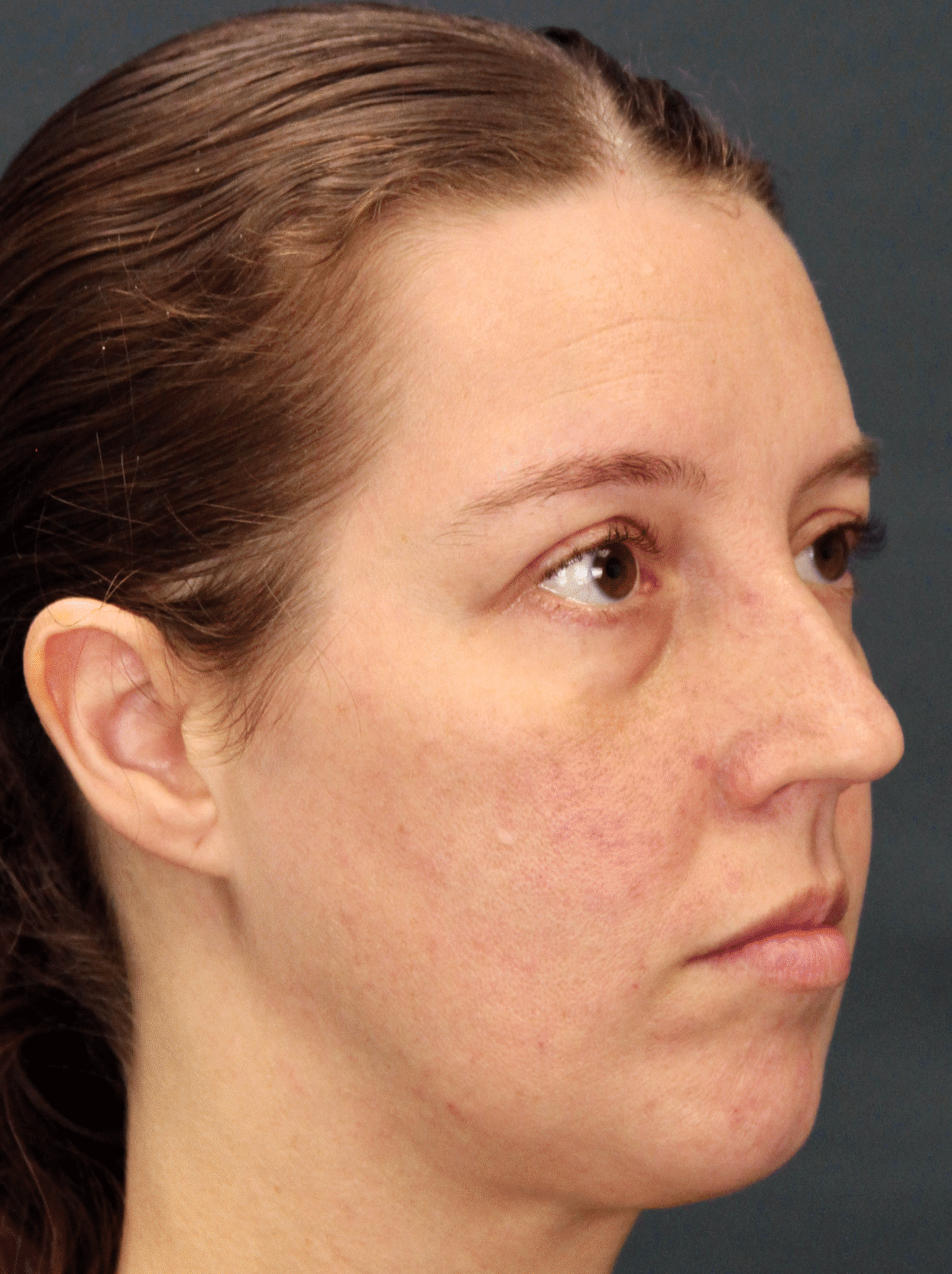 Before Image: Lower Lid Blepharoplasty with Fat Transposition, Facial Fat Grafting, and Deep Laser Resurfacing - right-front-oblique