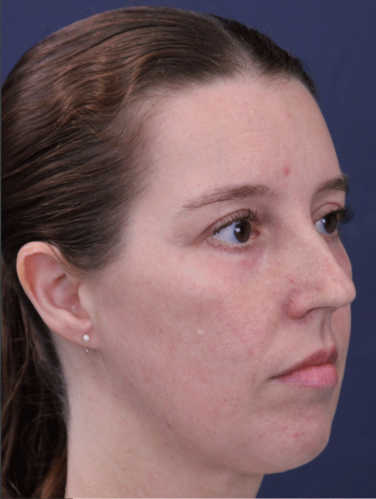 After Image: Lower Lid Blepharoplasty with Fat Transposition, Facial Fat Grafting, and Deep Laser Resurfacing - right-front-oblique