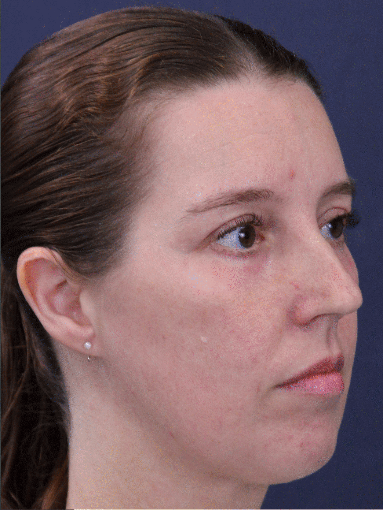 After Image: Lower Eyelid Lift with Fat Transposition, Under Eye Deep Laser & Facial Fat Grafting - right-front-oblique