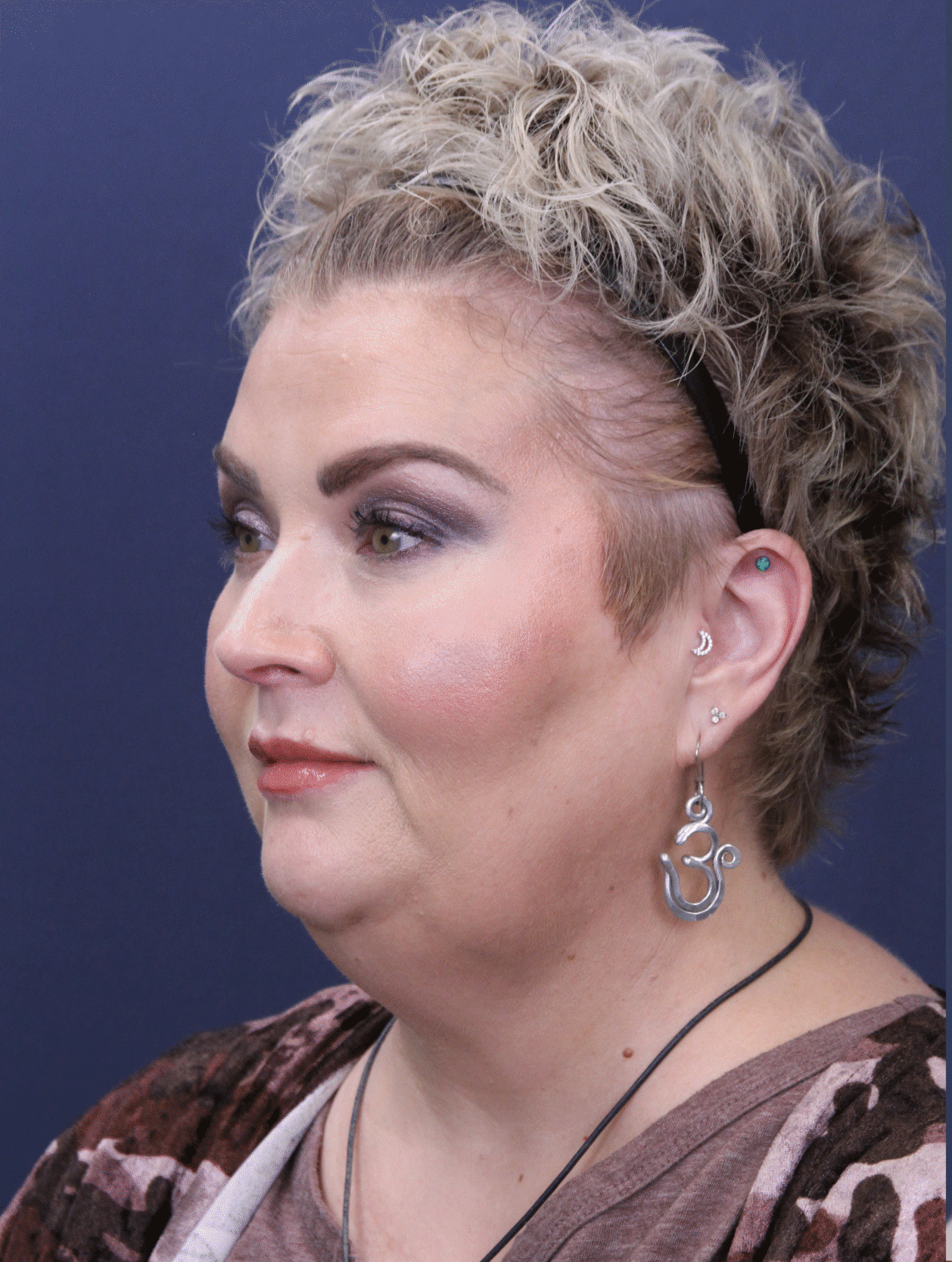 Before Image: Neck Lift - left-front-oblique