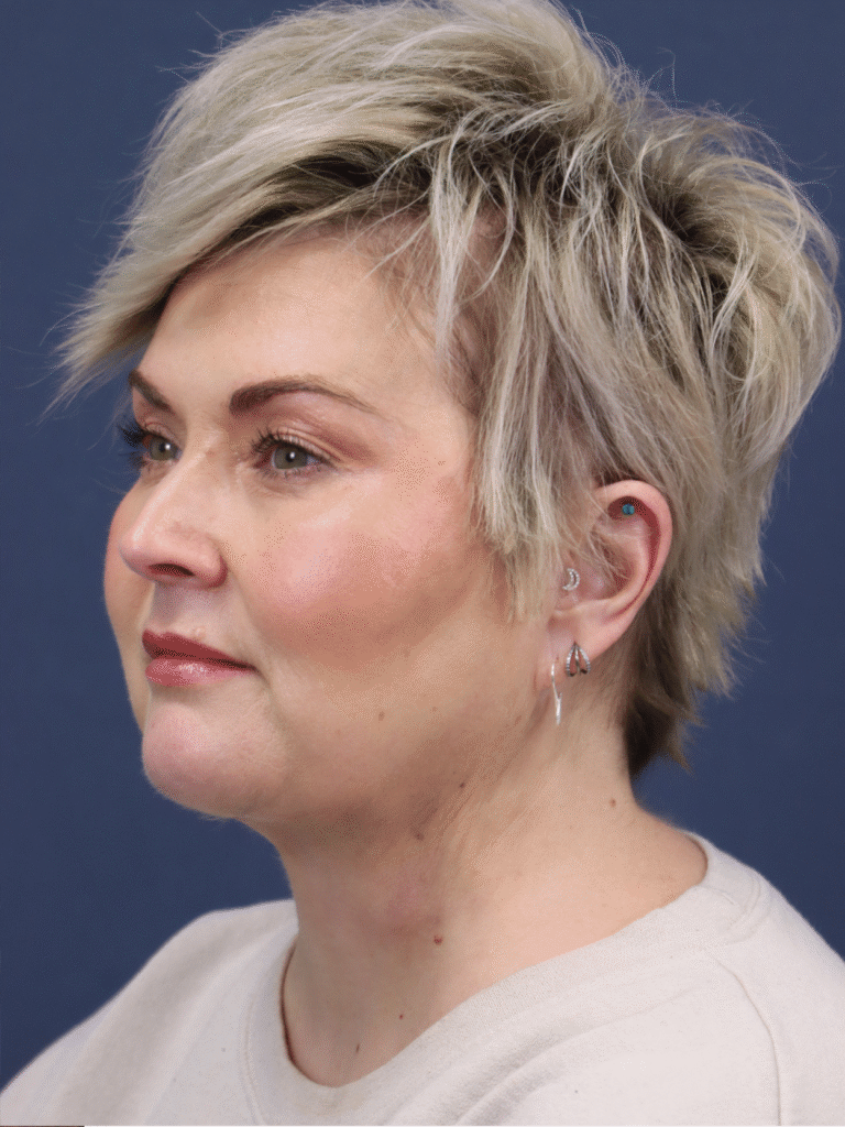 After Image: Neck Lift - left-front-oblique
