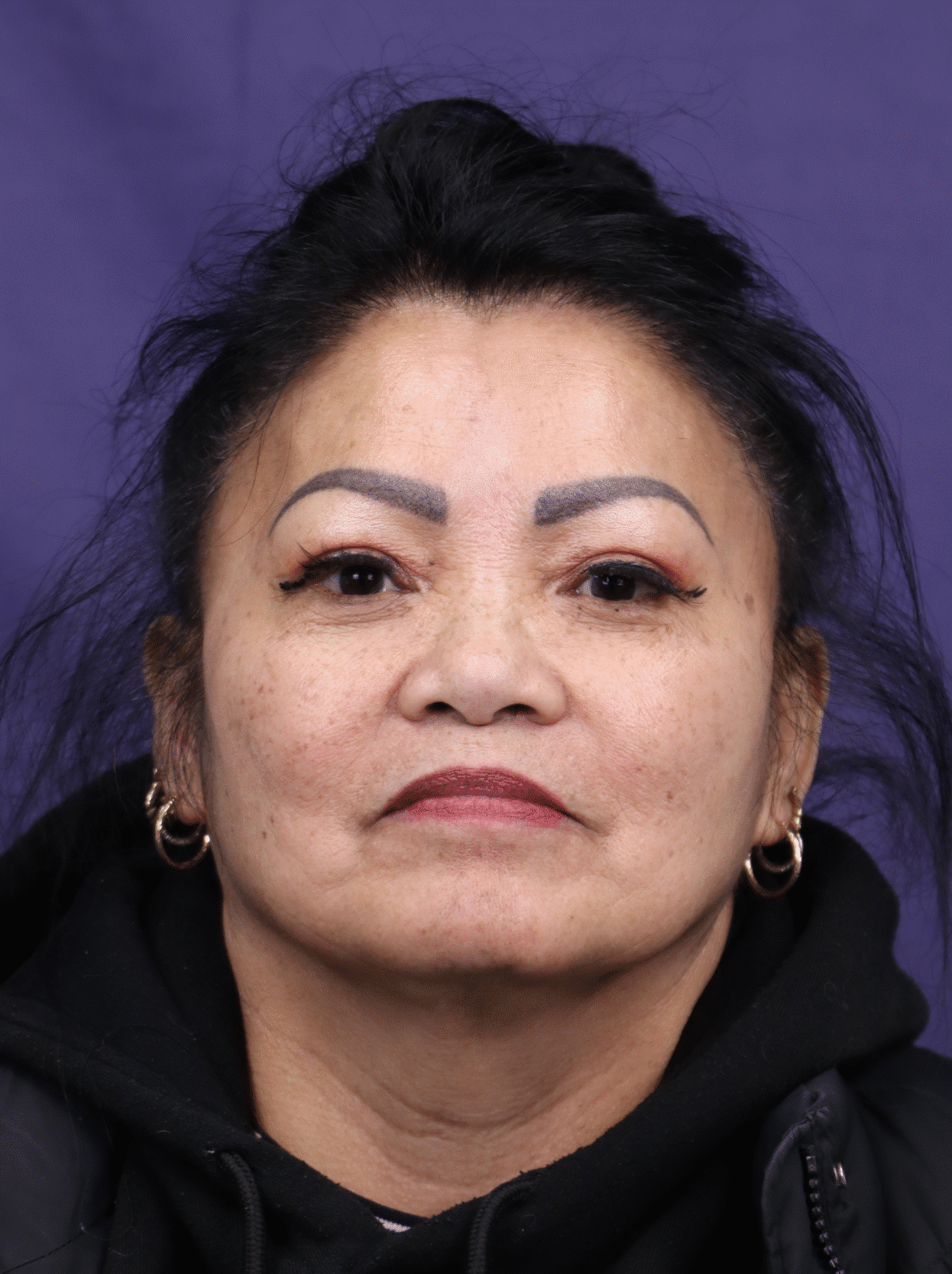 Before Image: Facial Fat Grafting - front