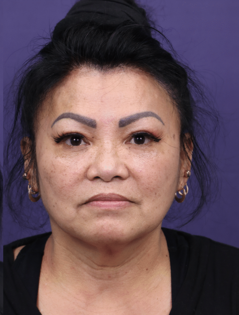 After Image: Facial Fat Grafting - front