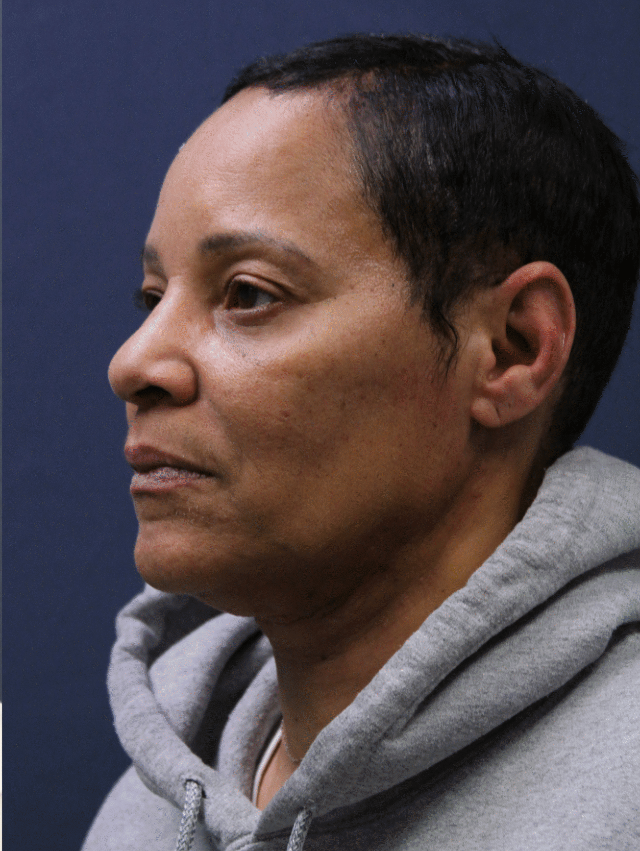 After Image: Minimally Invasive Neck Lift & Submental Liposuction - left-front-oblique