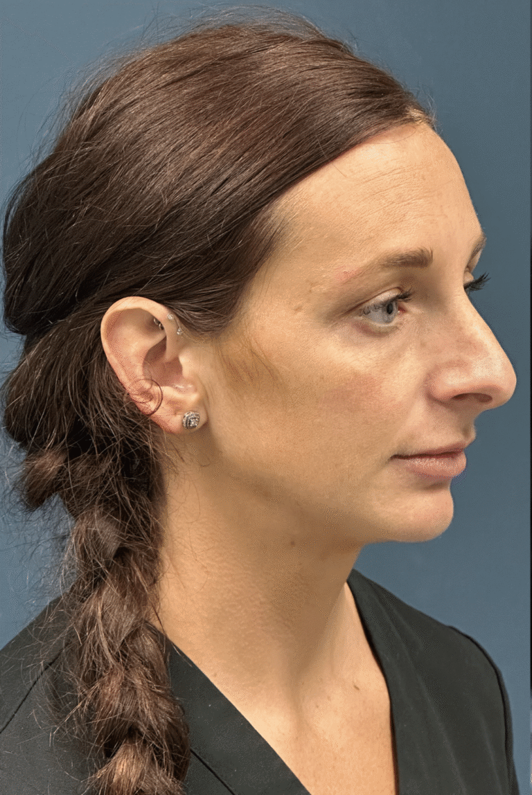 Before Image: Rhinoplasty - front