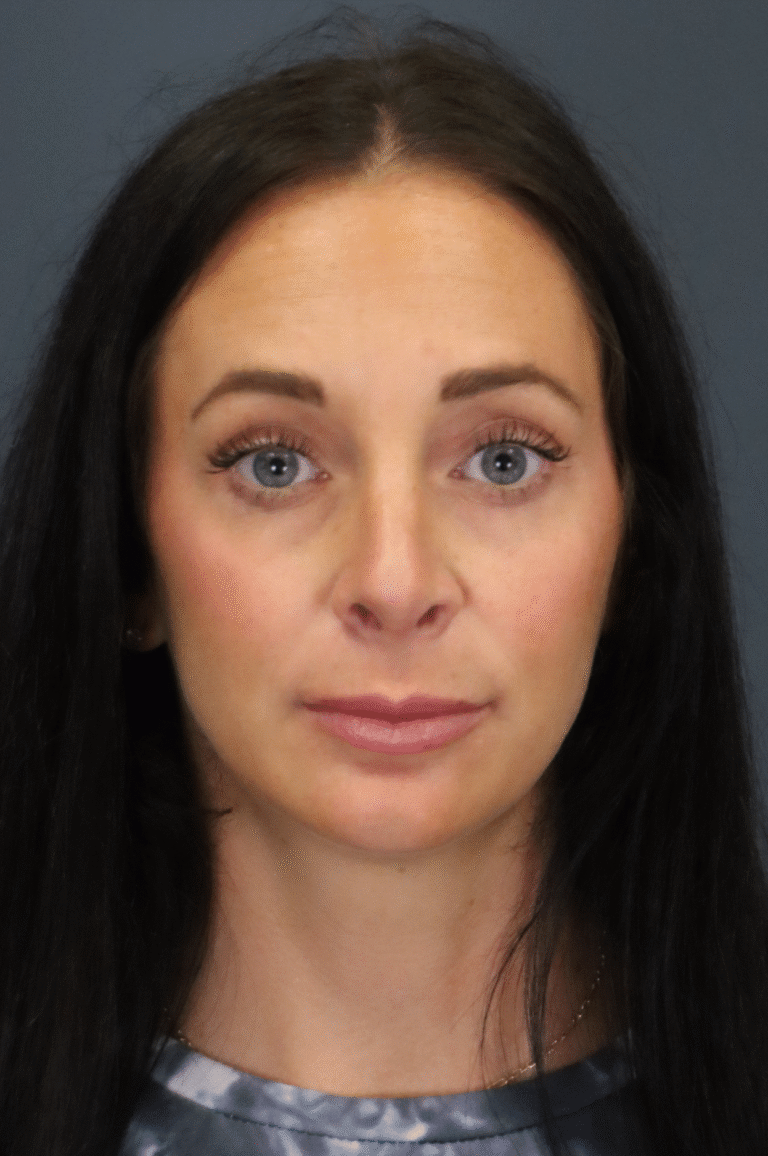 After Image: Septorhinoplasty - front