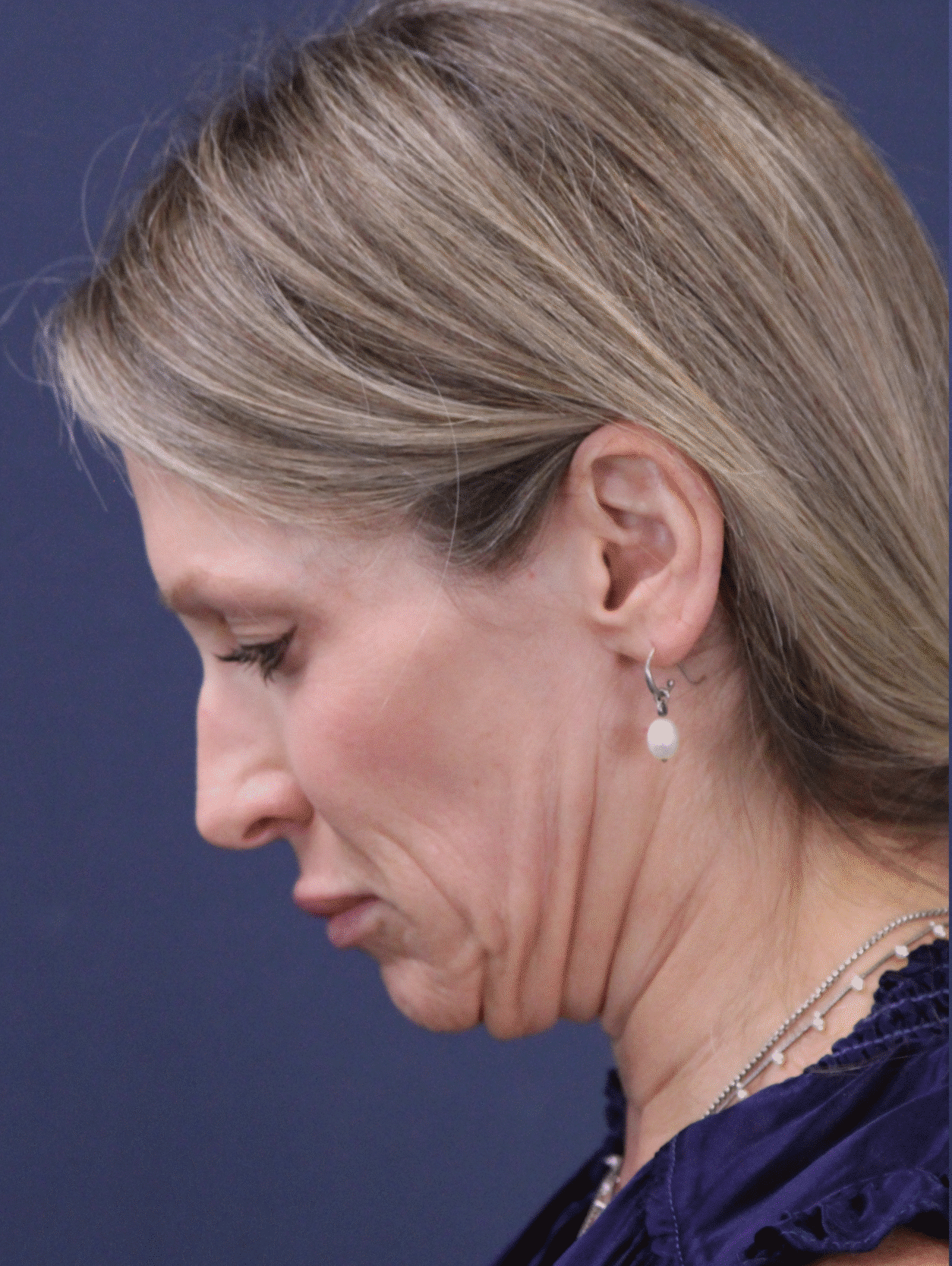 Before Image: MyEllevate Minimally Invasive Neck Lift - left-side