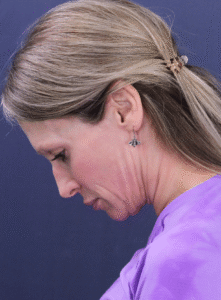 After Image: MyEllevate Minimally Invasive Neck Lift