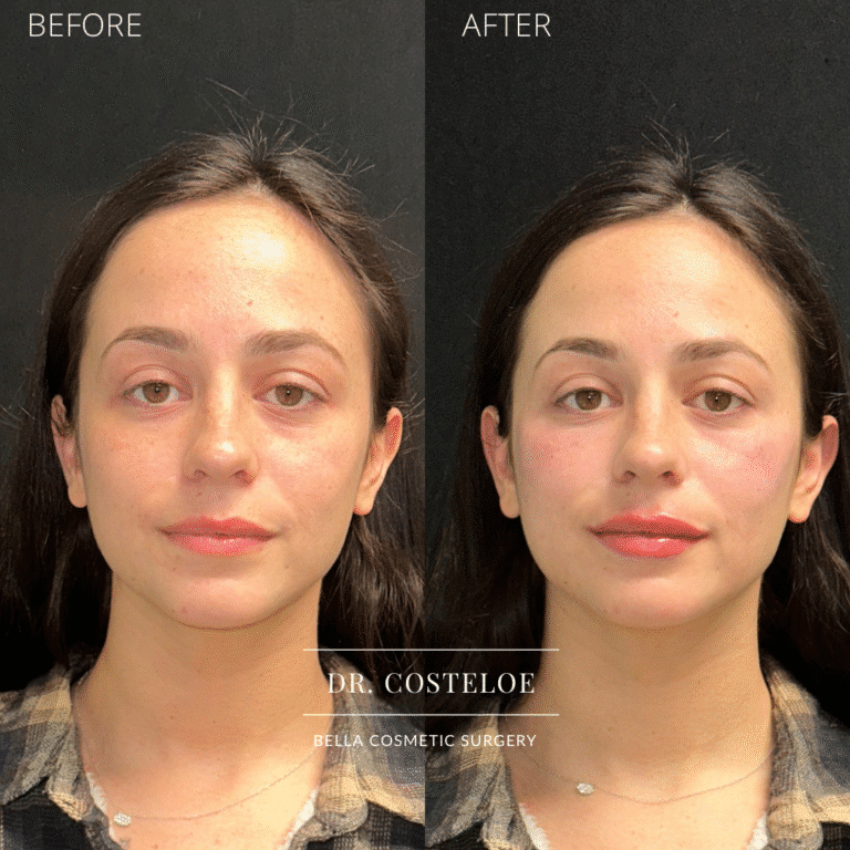 After Image: Facial rebalancing with hyaluronic acid filler - front