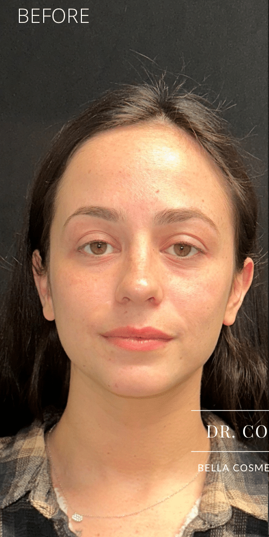 Before Image: Facial rebalancing with hyaluronic acid filler - front