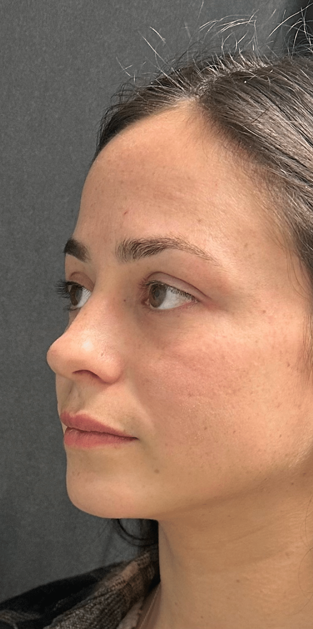 Before Image: Facial rebalancing with hyaluronic acid filler - left-front-oblique