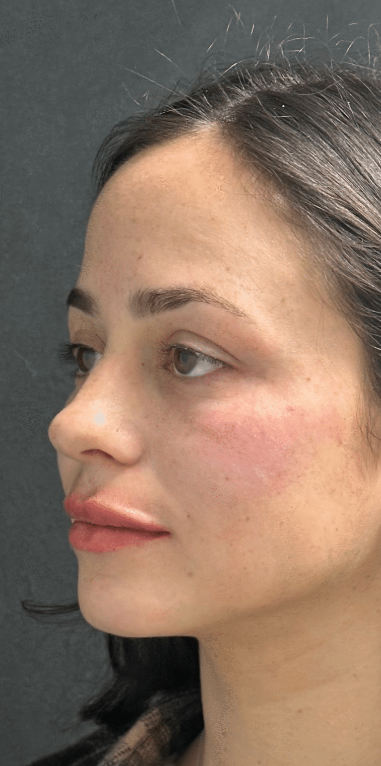 After Image: Facial rebalancing with hyaluronic acid filler - left-front-oblique