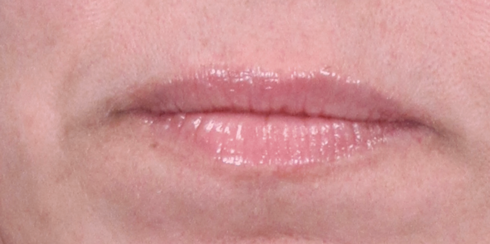 Before Image: Lip Filler by Dr. Costeloe