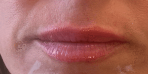 After Image: Lip Filler by Dr. Costeloe