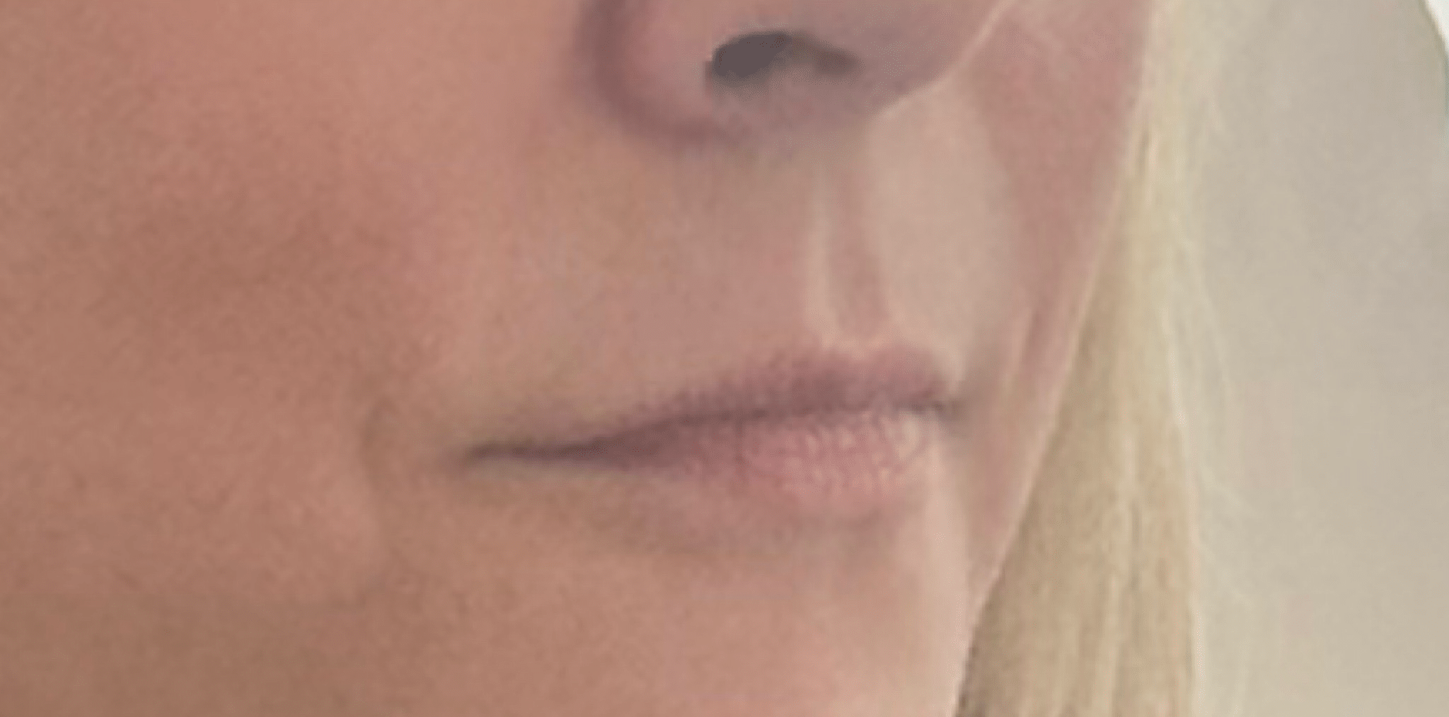 Before Image: Lip Filler by Dr. Costeloe - right-front-oblique
