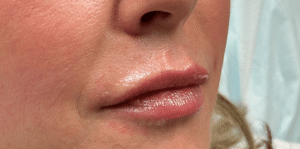 After Image: Lip Filler by Dr. Costeloe