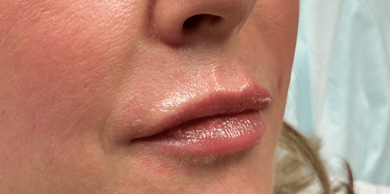 After Image: Lip Filler by Dr. Costeloe - right-front-oblique