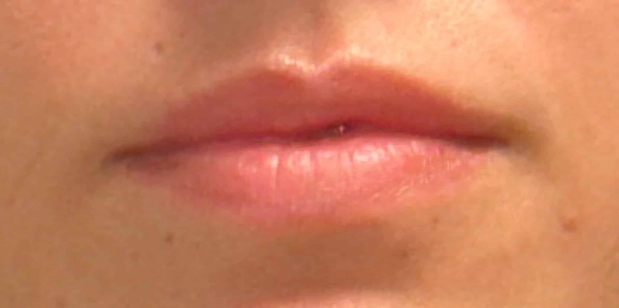 Before Image: Lip Filler by Dr. Costeloe - front