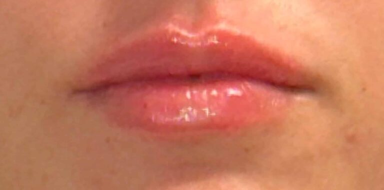 After Image: Lip Filler by Dr. Costeloe - front
