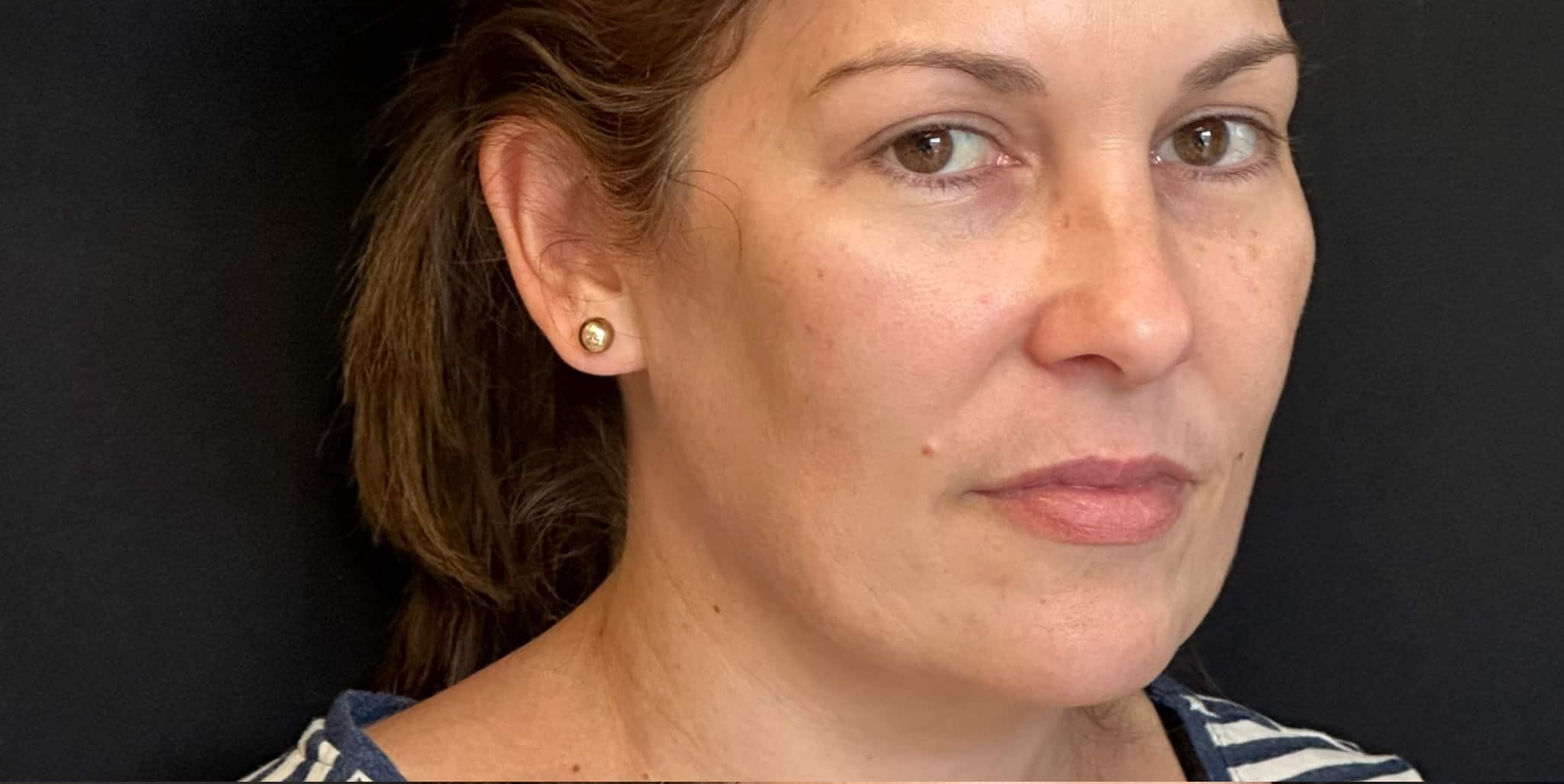 Before Image: Lip Filler by Dr. Costeloe