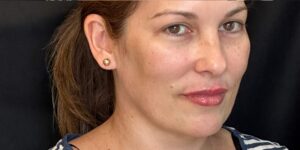 After Image: Lip Filler by Dr. Costeloe